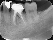 Molar apicectomy - Pre-op